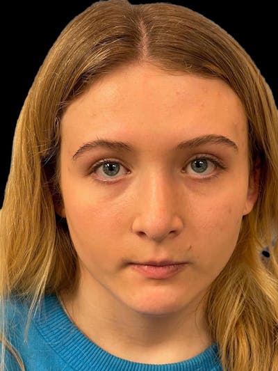Rhinoplasty Before & After Gallery - Patient 315883 - Image 2