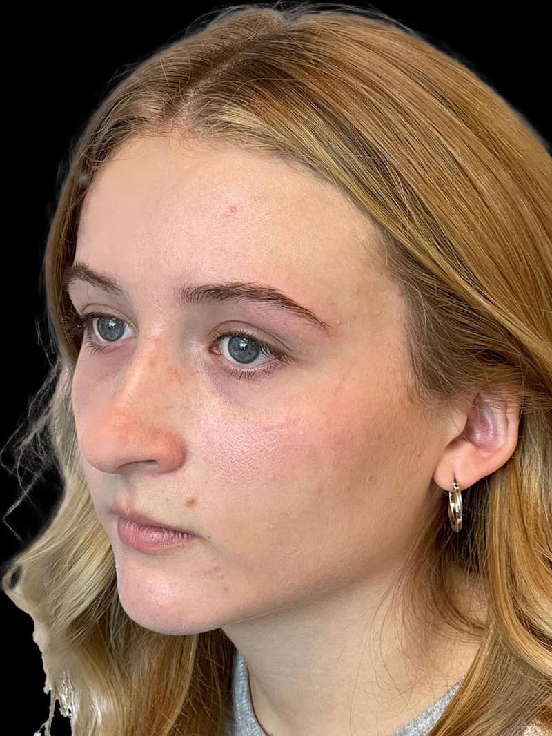 Rhinoplasty Before & After Gallery - Patient 315883 - Image 3
