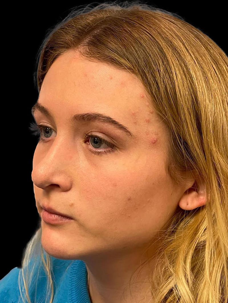 Rhinoplasty Before & After Gallery - Patient 315883 - Image 4