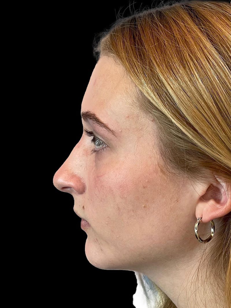 Rhinoplasty Before & After Gallery - Patient 315883 - Image 5