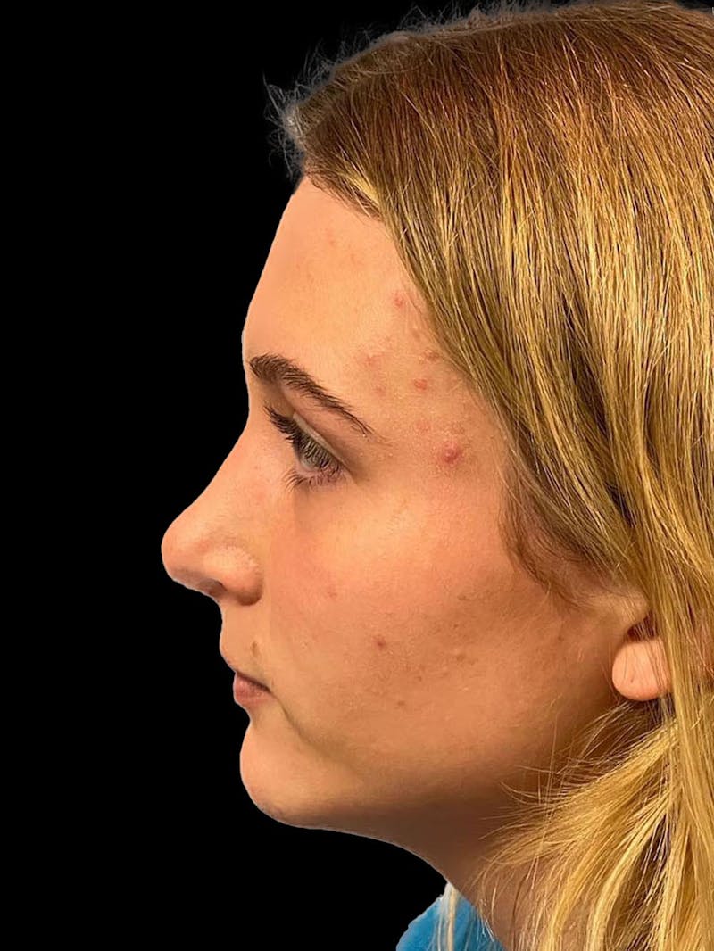 Rhinoplasty Before & After Gallery - Patient 315883 - Image 6