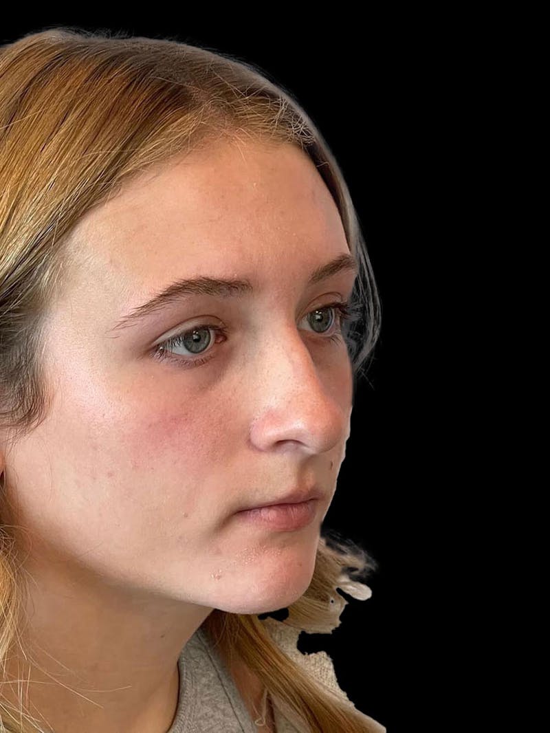 Rhinoplasty Before & After Gallery - Patient 315883 - Image 7