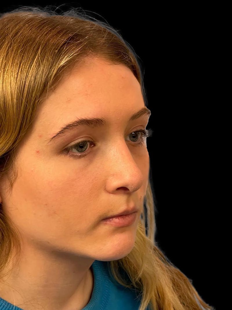 Rhinoplasty Before & After Gallery - Patient 315883 - Image 8