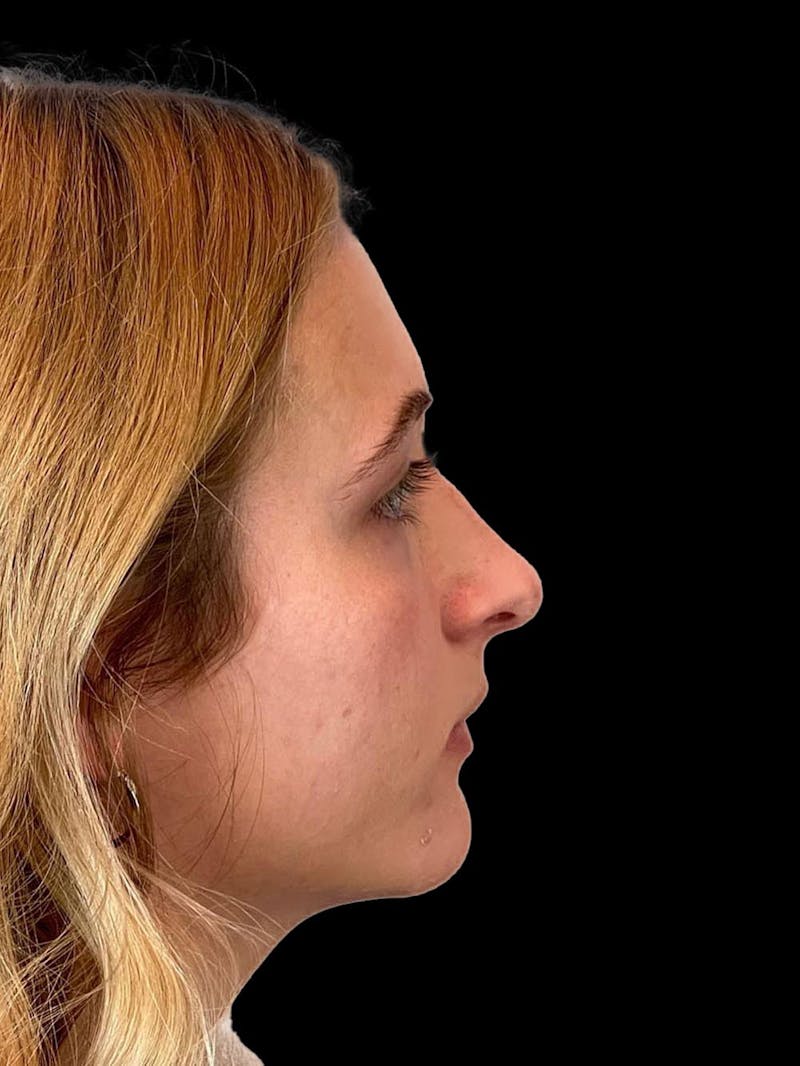 Rhinoplasty Before & After Gallery - Patient 315883 - Image 9