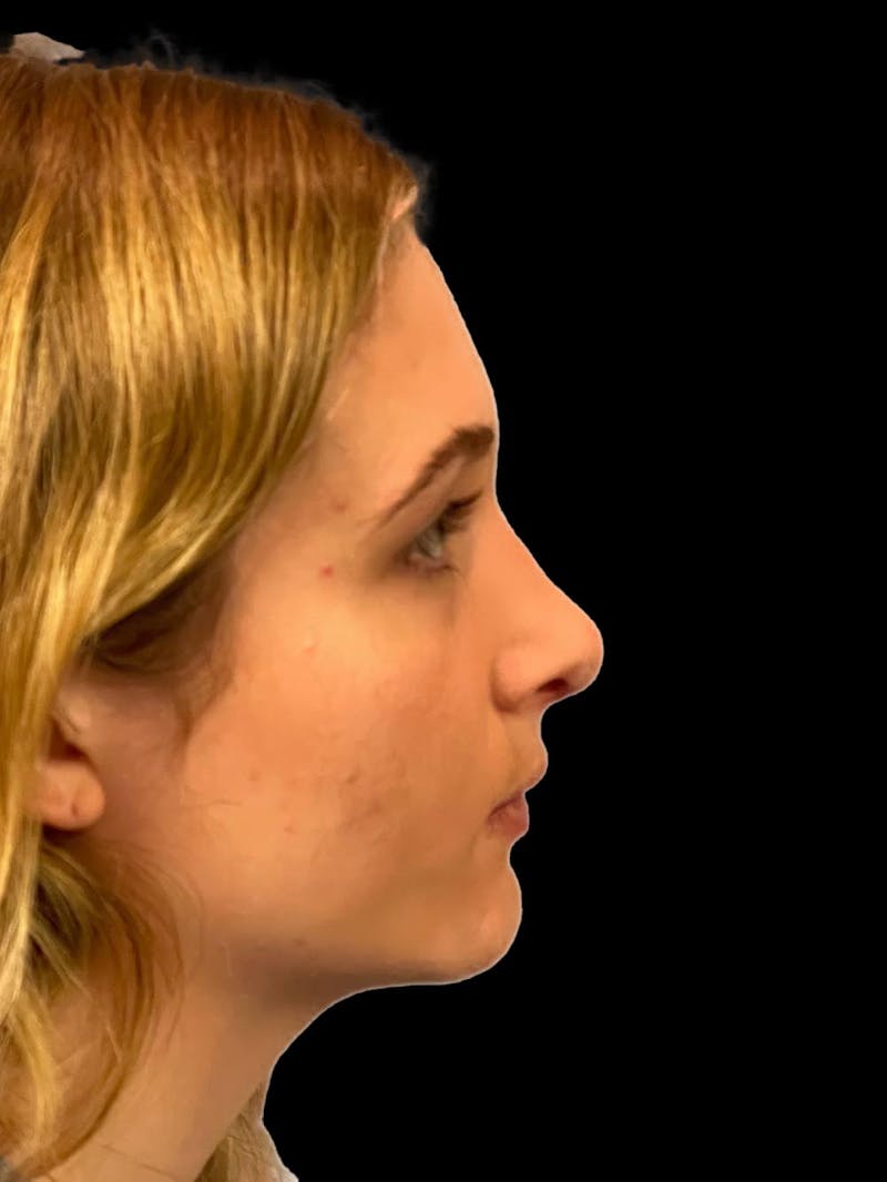 Rhinoplasty Before & After Gallery - Patient 315883 - Image 10