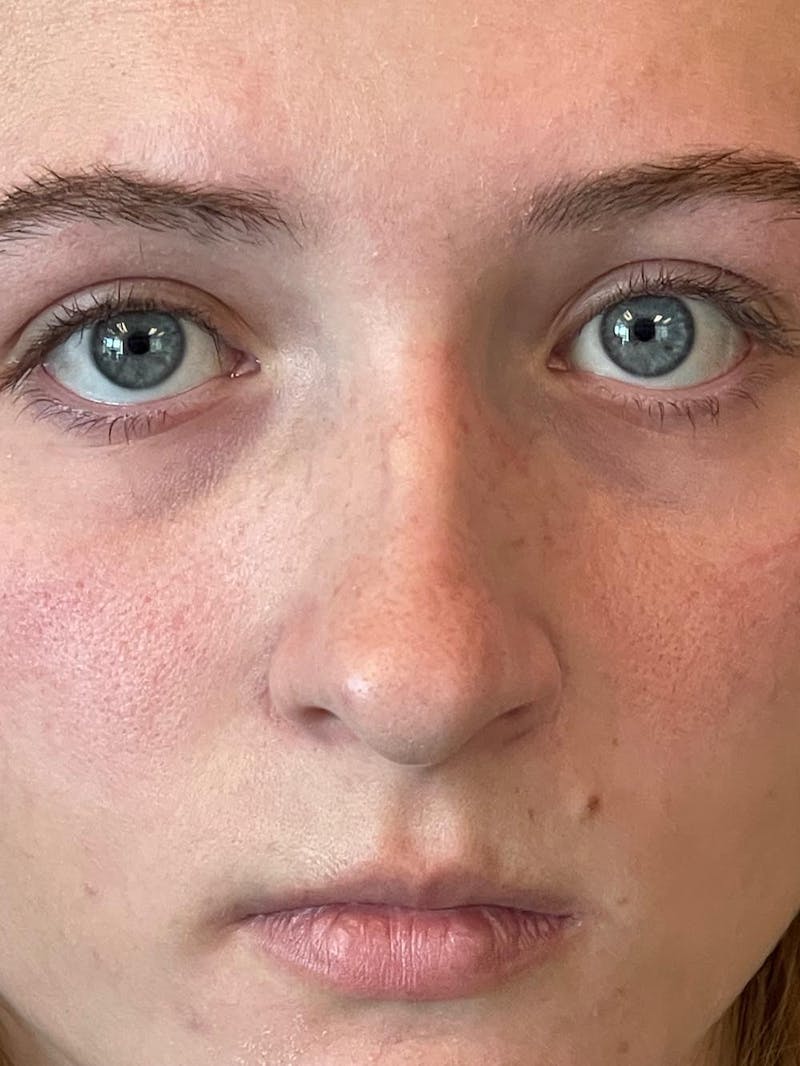 Rhinoplasty Before & After Gallery - Patient 315883 - Image 11