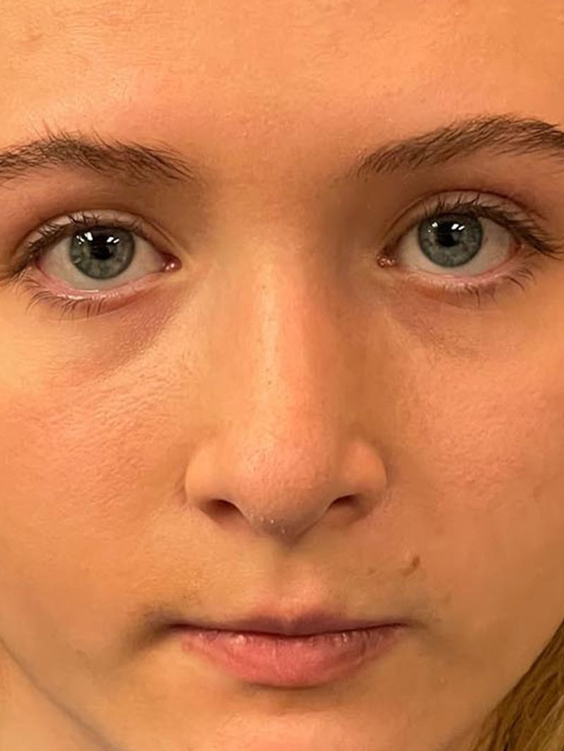 Rhinoplasty Before & After Gallery - Patient 315883 - Image 12