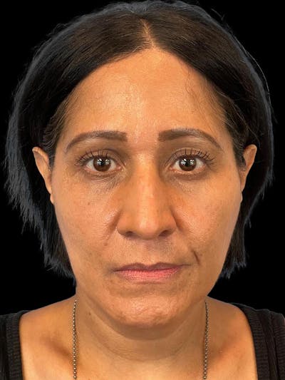 Rhinoplasty Before & After Gallery - Patient 330424 - Image 1