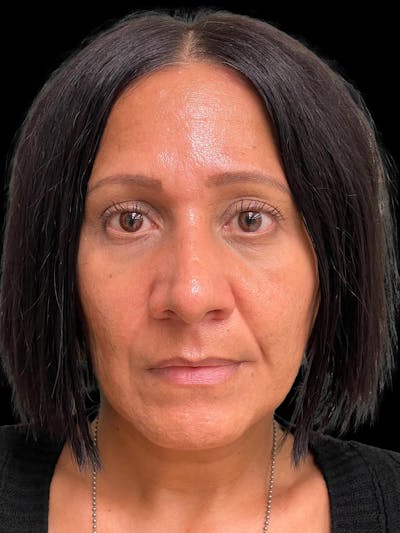 Rhinoplasty Before & After Gallery - Patient 330424 - Image 2