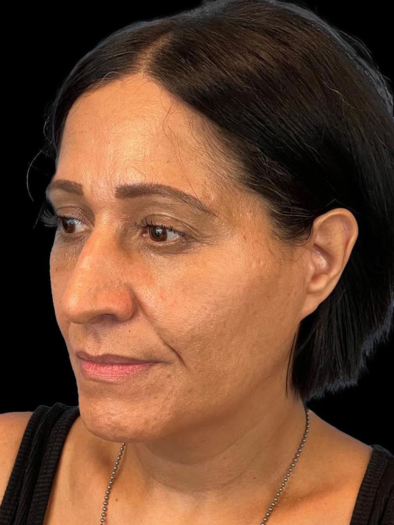 Rhinoplasty Before & After Gallery - Patient 330424 - Image 3