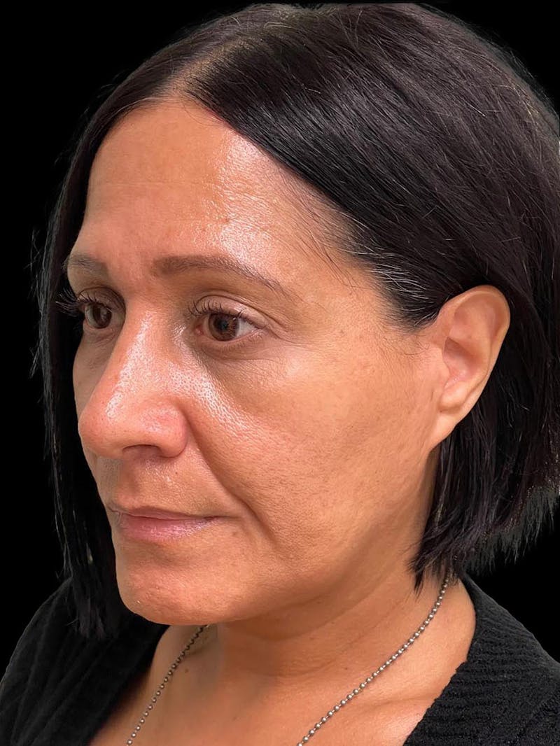 Rhinoplasty Before & After Gallery - Patient 330424 - Image 4