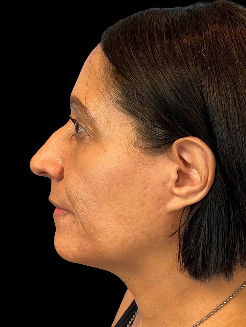 Rhinoplasty Before & After Gallery - Patient 330424 - Image 5