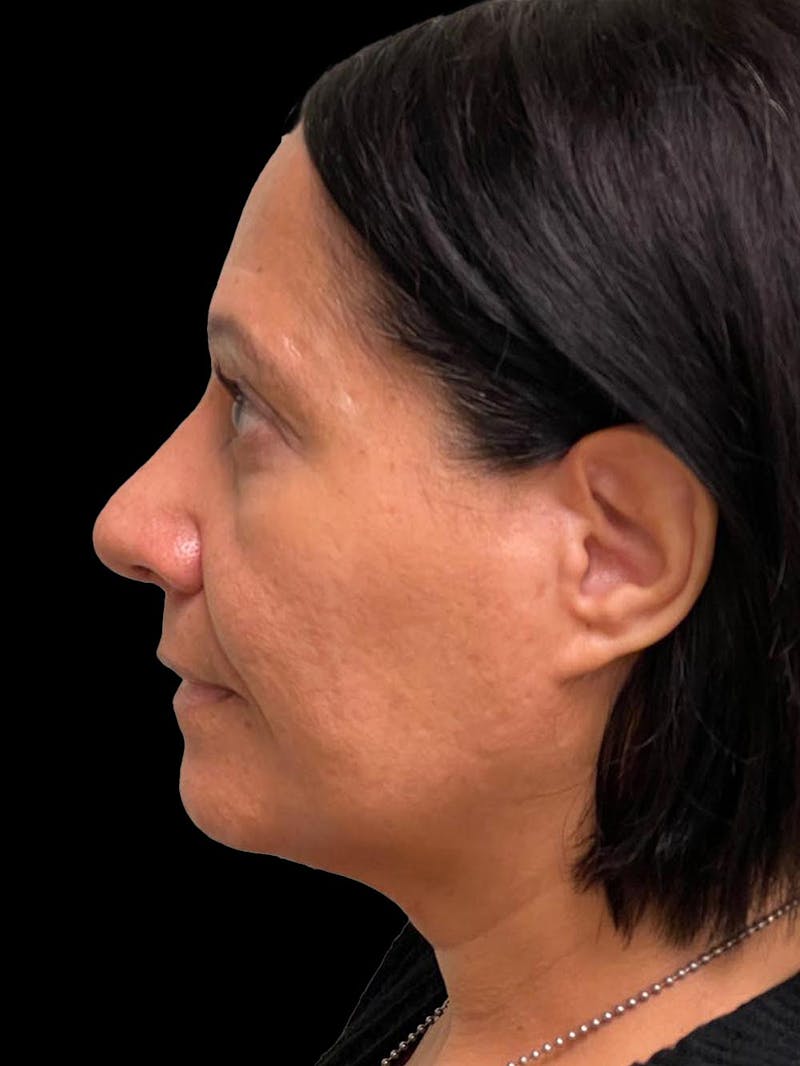 Rhinoplasty Before & After Gallery - Patient 330424 - Image 6