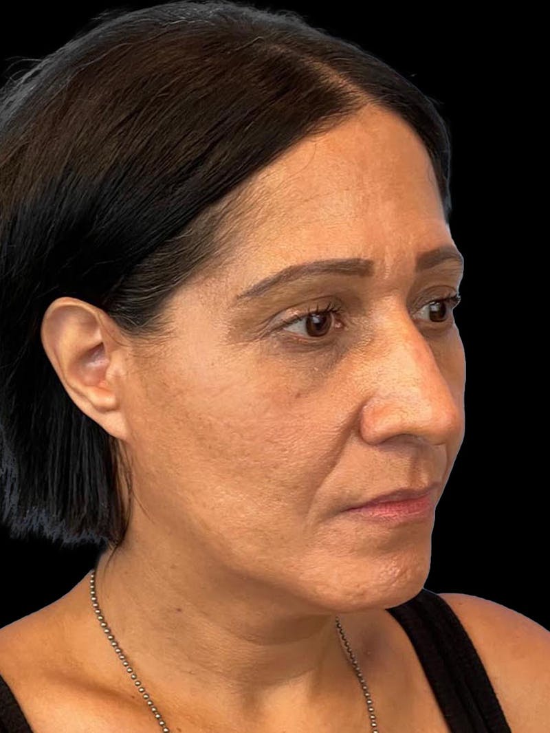 Rhinoplasty Before & After Gallery - Patient 330424 - Image 7