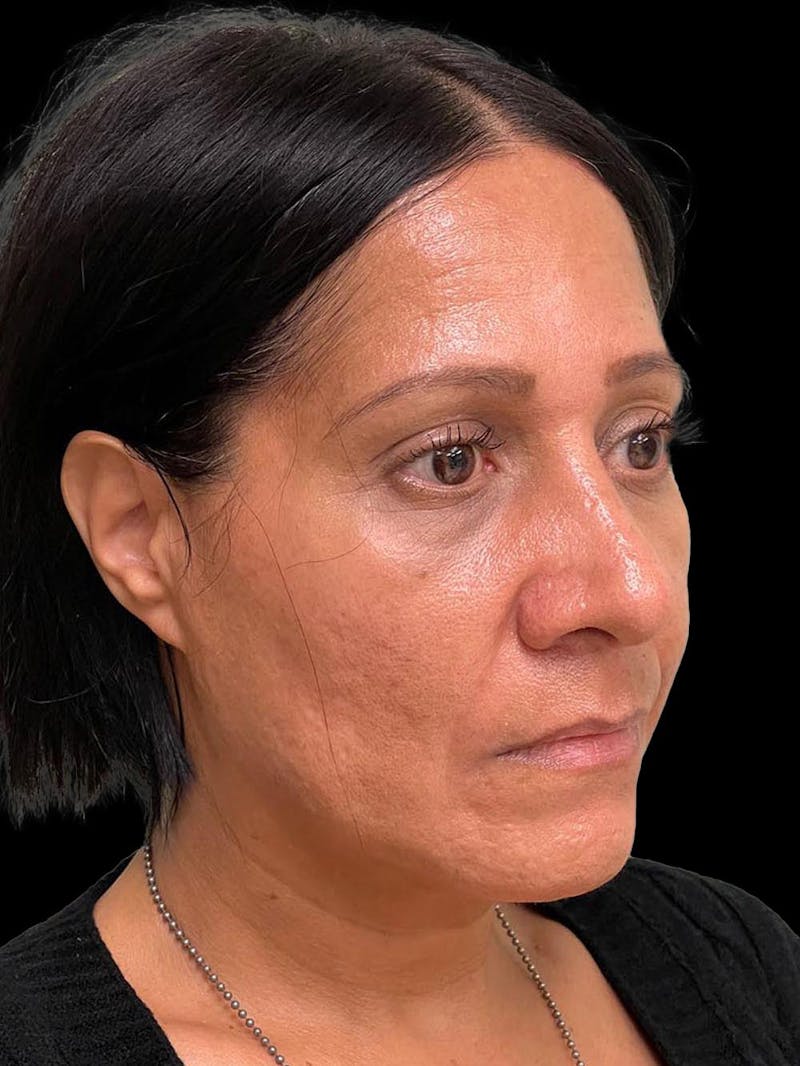 Rhinoplasty Before & After Gallery - Patient 330424 - Image 8