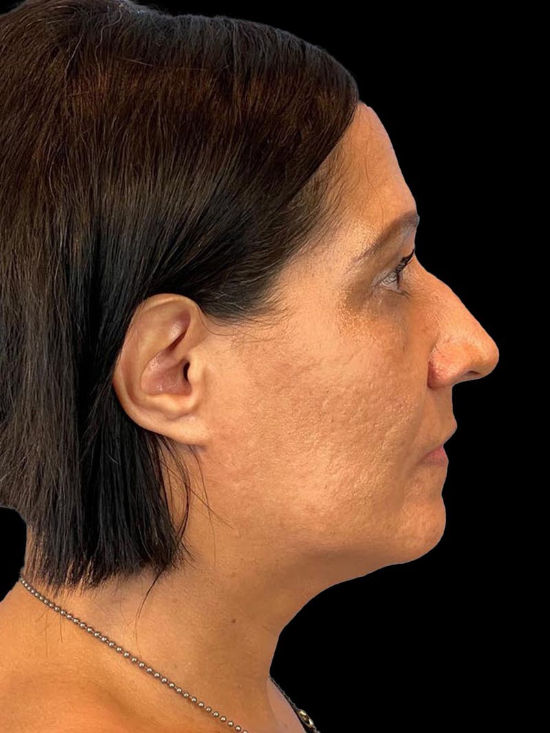 Rhinoplasty Before & After Gallery - Patient 330424 - Image 9