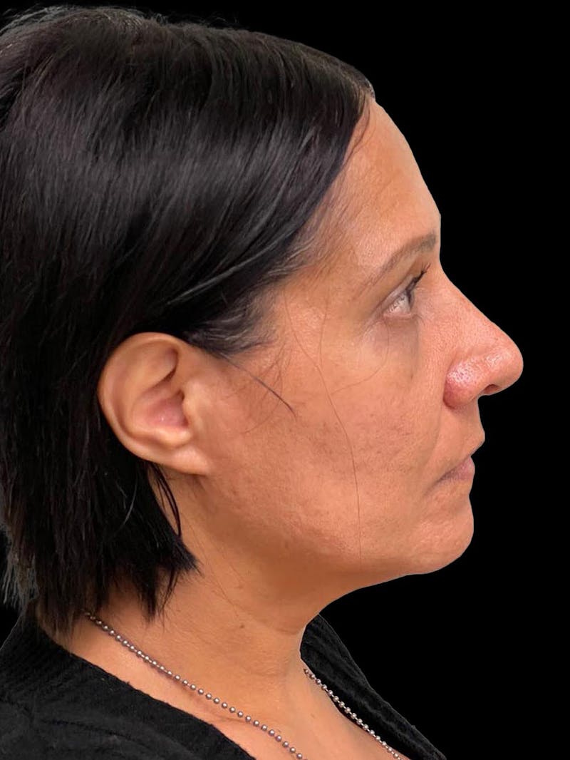 Rhinoplasty Before & After Gallery - Patient 330424 - Image 10