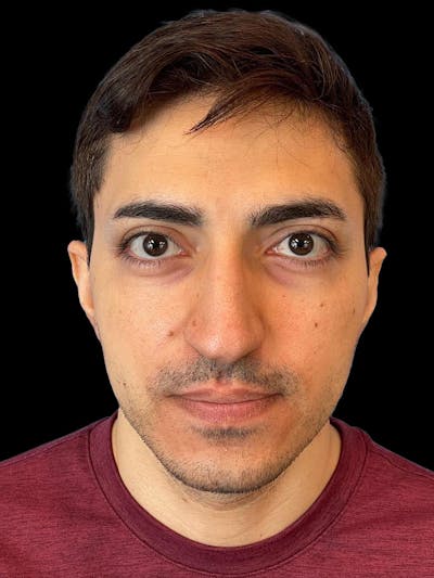Rhinoplasty Before & After Gallery - Patient 226465 - Image 1