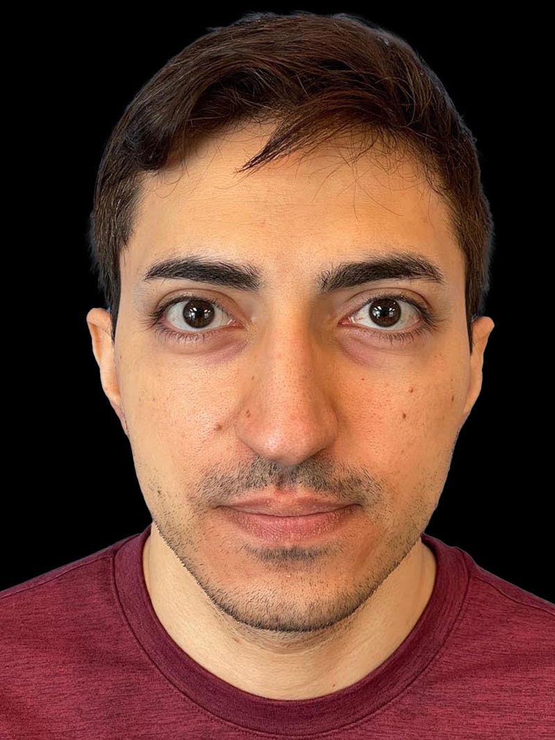 Rhinoplasty Before & After Gallery - Patient 226465 - Image 1