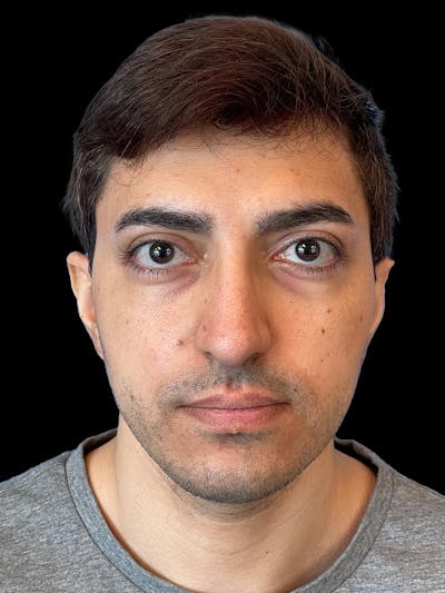 Rhinoplasty Before & After Gallery - Patient 226465 - Image 2