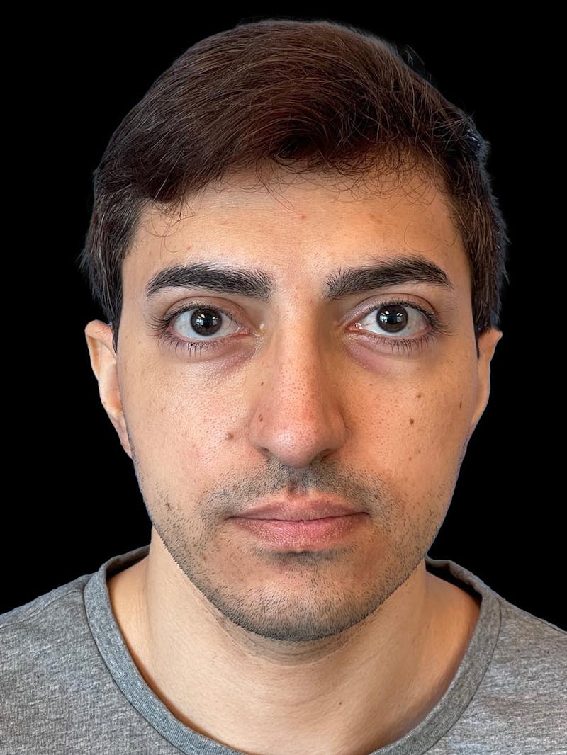 Rhinoplasty Before & After Gallery - Patient 226465 - Image 2