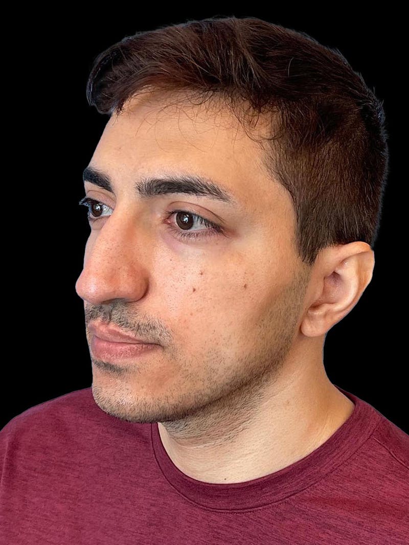 Rhinoplasty Before & After Gallery - Patient 226465 - Image 3