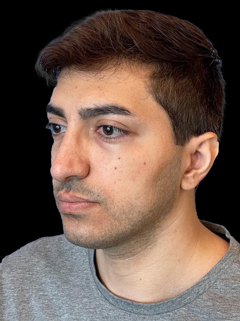 Rhinoplasty Before & After Gallery - Patient 226465 - Image 4