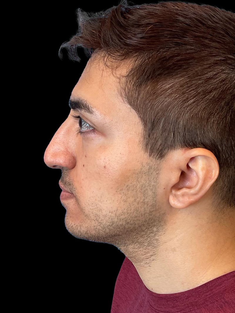Rhinoplasty Before & After Gallery - Patient 226465 - Image 5