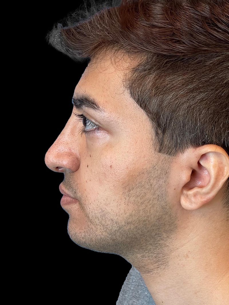 Rhinoplasty Before & After Gallery - Patient 226465 - Image 6