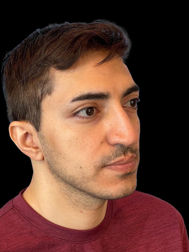 Rhinoplasty Before & After Gallery - Patient 226465 - Image 7