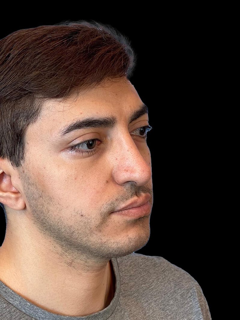Rhinoplasty Before & After Gallery - Patient 226465 - Image 8