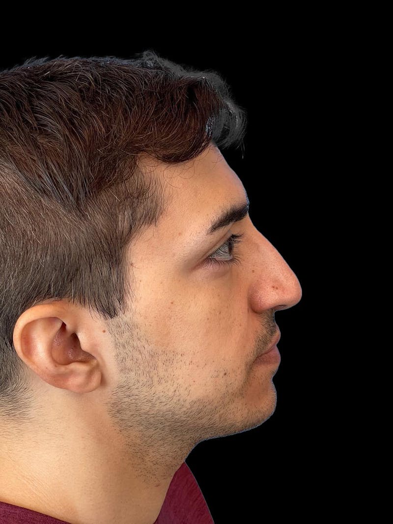 Rhinoplasty Before & After Gallery - Patient 226465 - Image 9