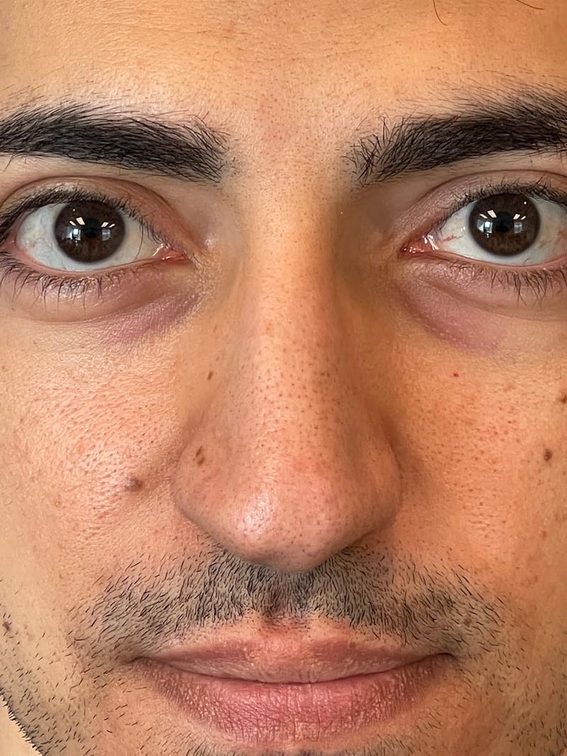 Rhinoplasty Before & After Gallery - Patient 226465 - Image 11