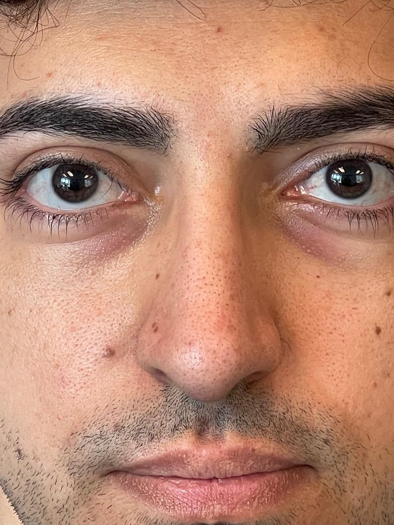 Rhinoplasty Before & After Gallery - Patient 226465 - Image 12