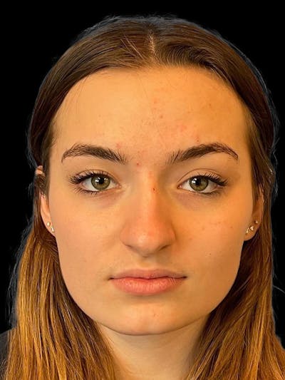 Rhinoplasty Before & After Gallery - Patient 260330 - Image 1