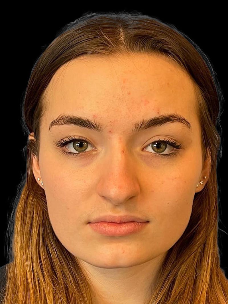 Rhinoplasty Before & After Gallery - Patient 260330 - Image 1