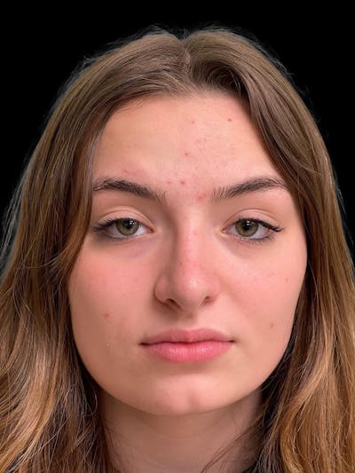 Rhinoplasty Before & After Gallery - Patient 260330 - Image 2