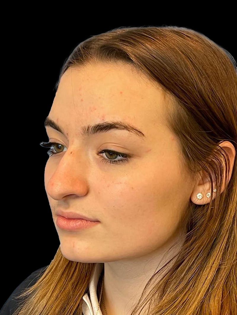 Rhinoplasty Before & After Gallery - Patient 260330 - Image 3