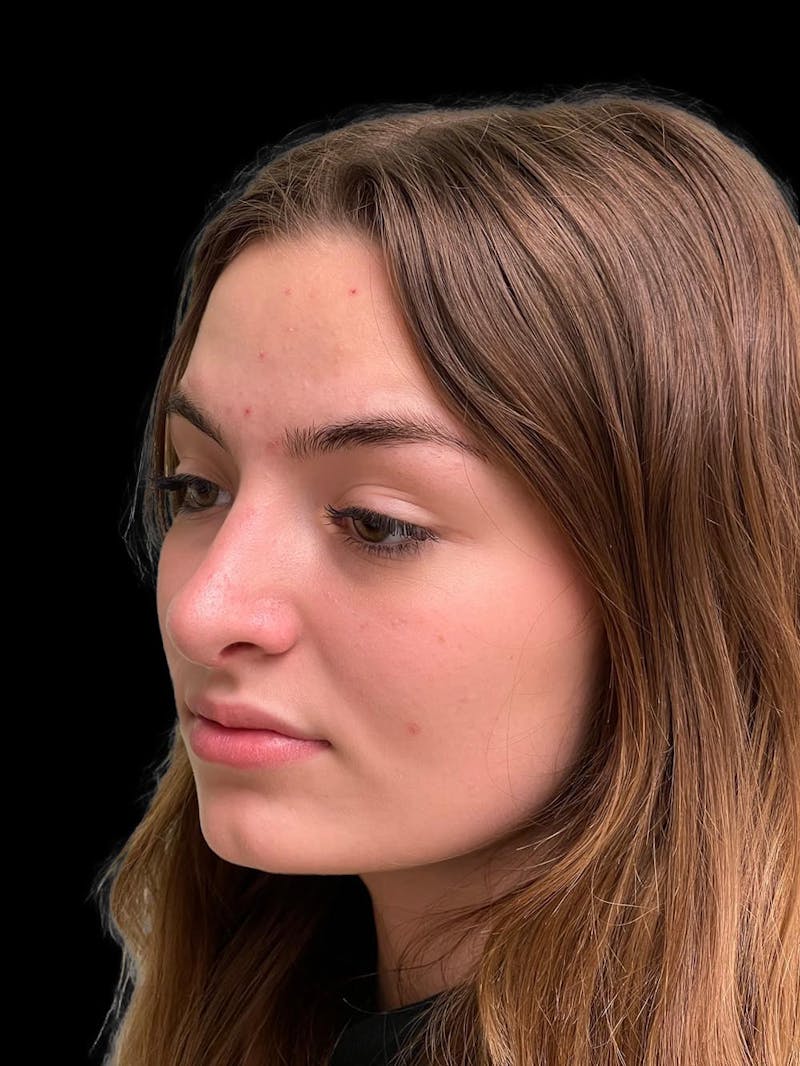 Rhinoplasty Before & After Gallery - Patient 260330 - Image 4