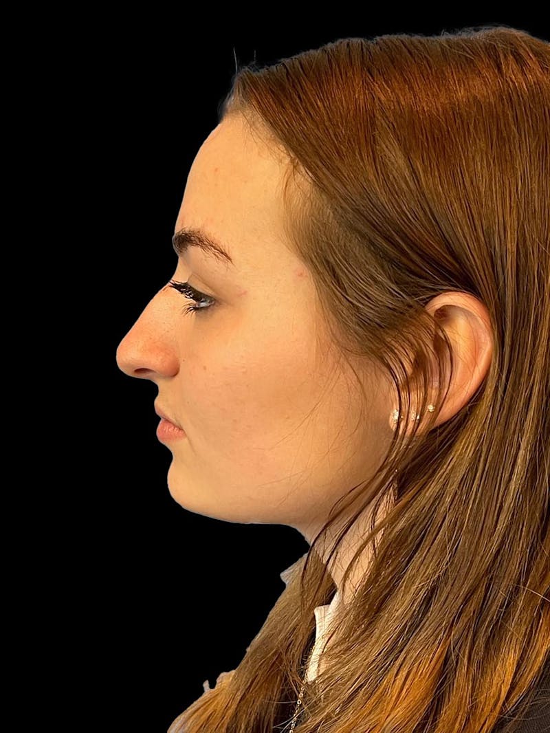 Rhinoplasty Before & After Gallery - Patient 260330 - Image 5