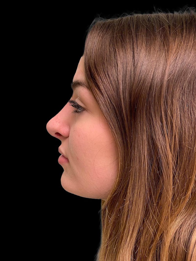 Rhinoplasty Before & After Gallery - Patient 260330 - Image 6
