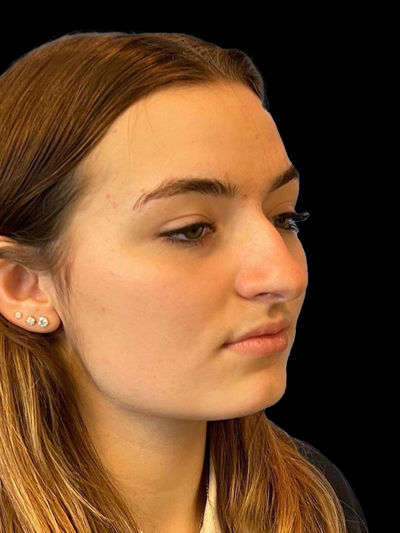 Rhinoplasty Before & After Gallery - Patient 260330 - Image 7