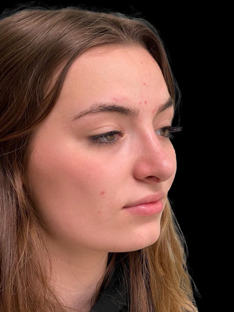 Rhinoplasty Before & After Gallery - Patient 260330 - Image 8