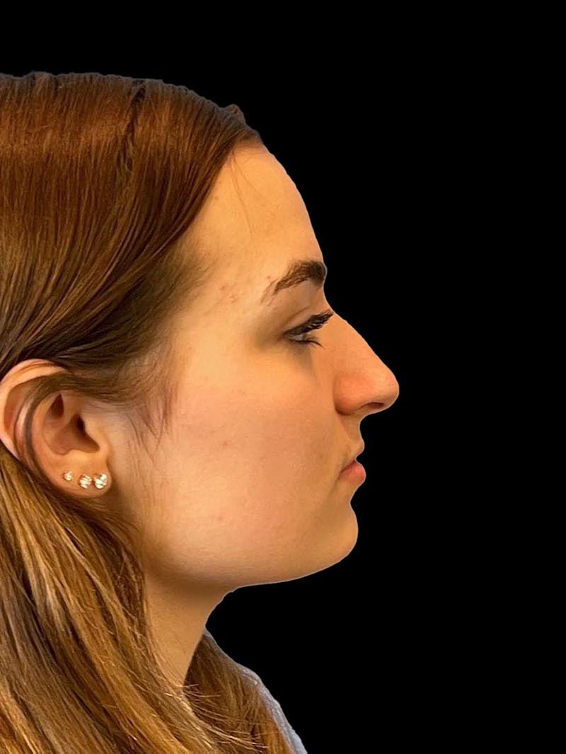 Rhinoplasty Before & After Gallery - Patient 260330 - Image 9