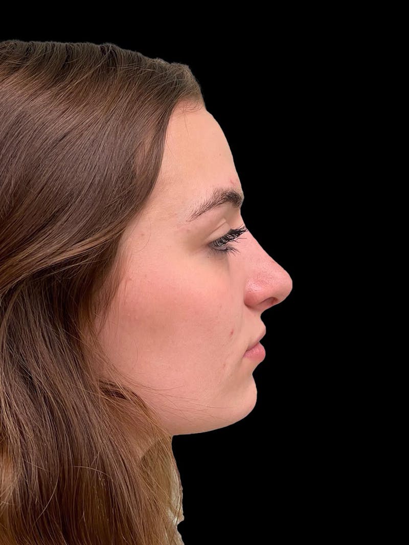 Rhinoplasty Before & After Gallery - Patient 260330 - Image 10