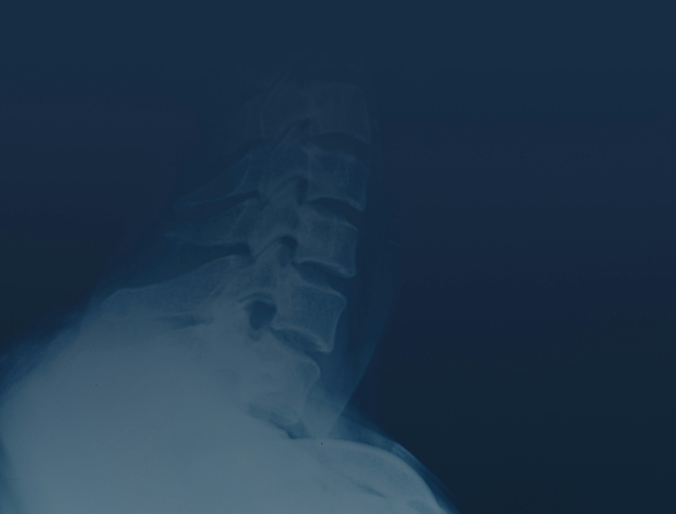 xray of a spine