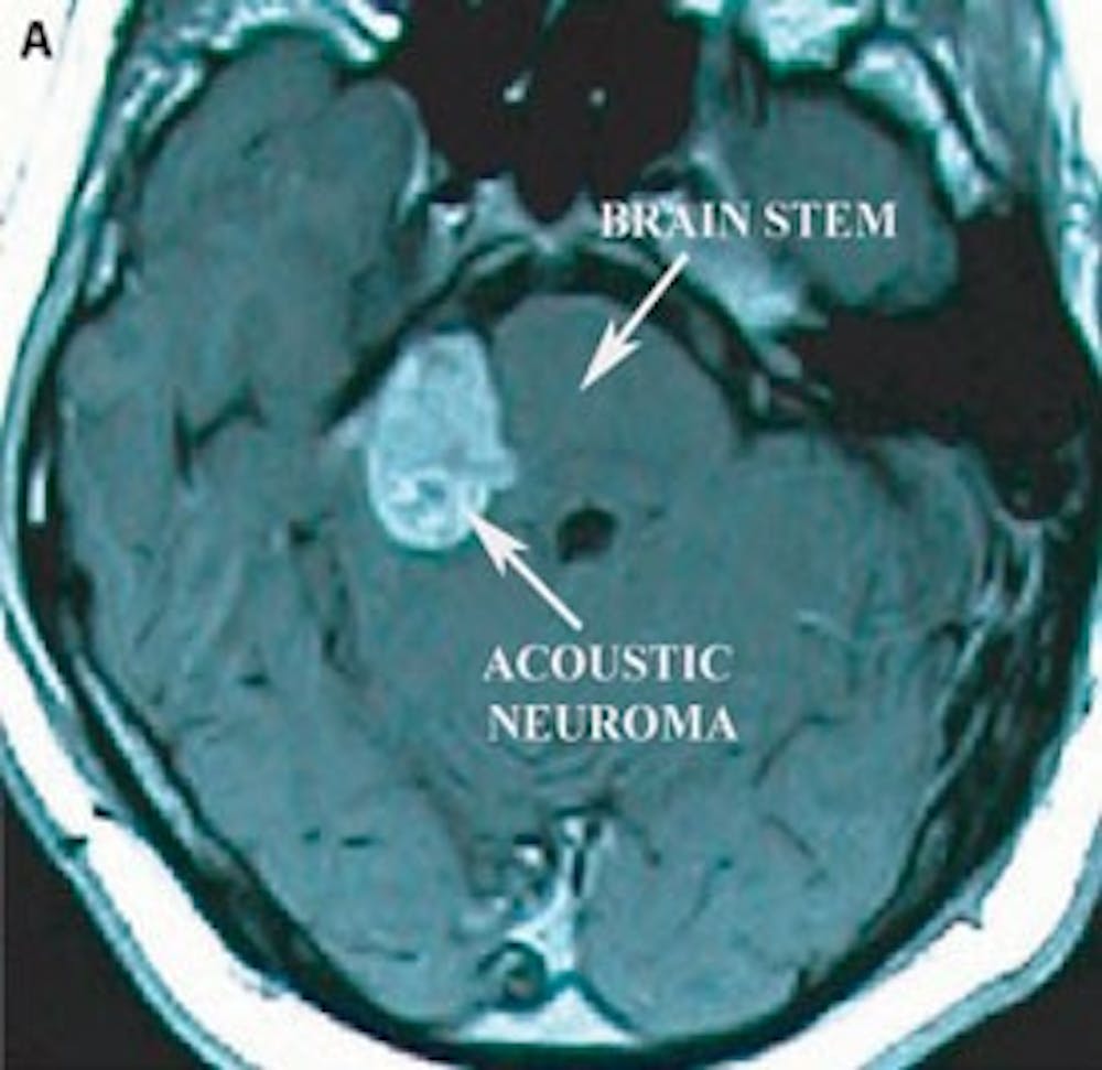 IRM T1 axiale préopératoire avec contraste montrant un volumineux neurinome acoustique comprimant le tronc cérébral.