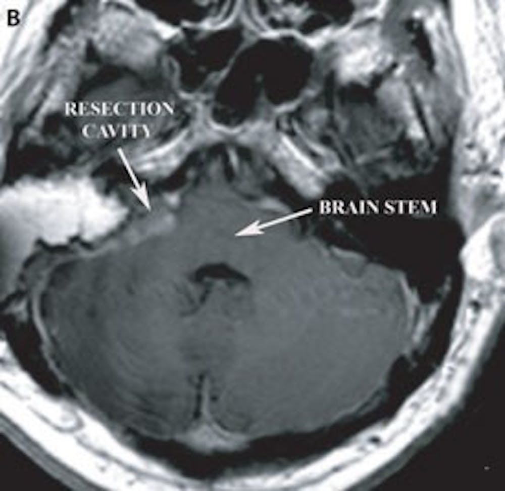 IRM T1 axiale postopératoire avec contraste montrant la cavité de résection chirurgicale et la résolution de la compression du tronc cérébral.