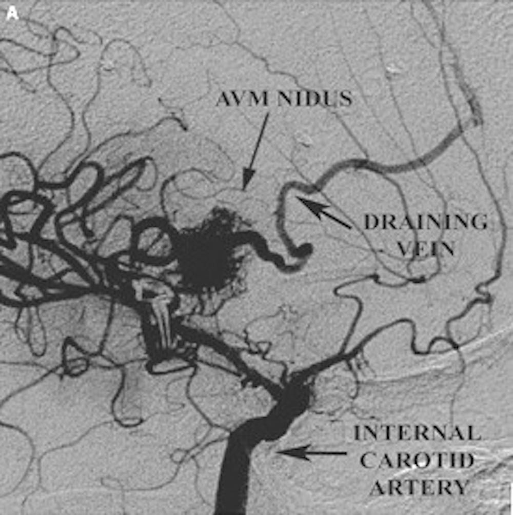 Angiographie latérale préopératoire montrant le nidus de la MAV et la veine de drainage superficielle.