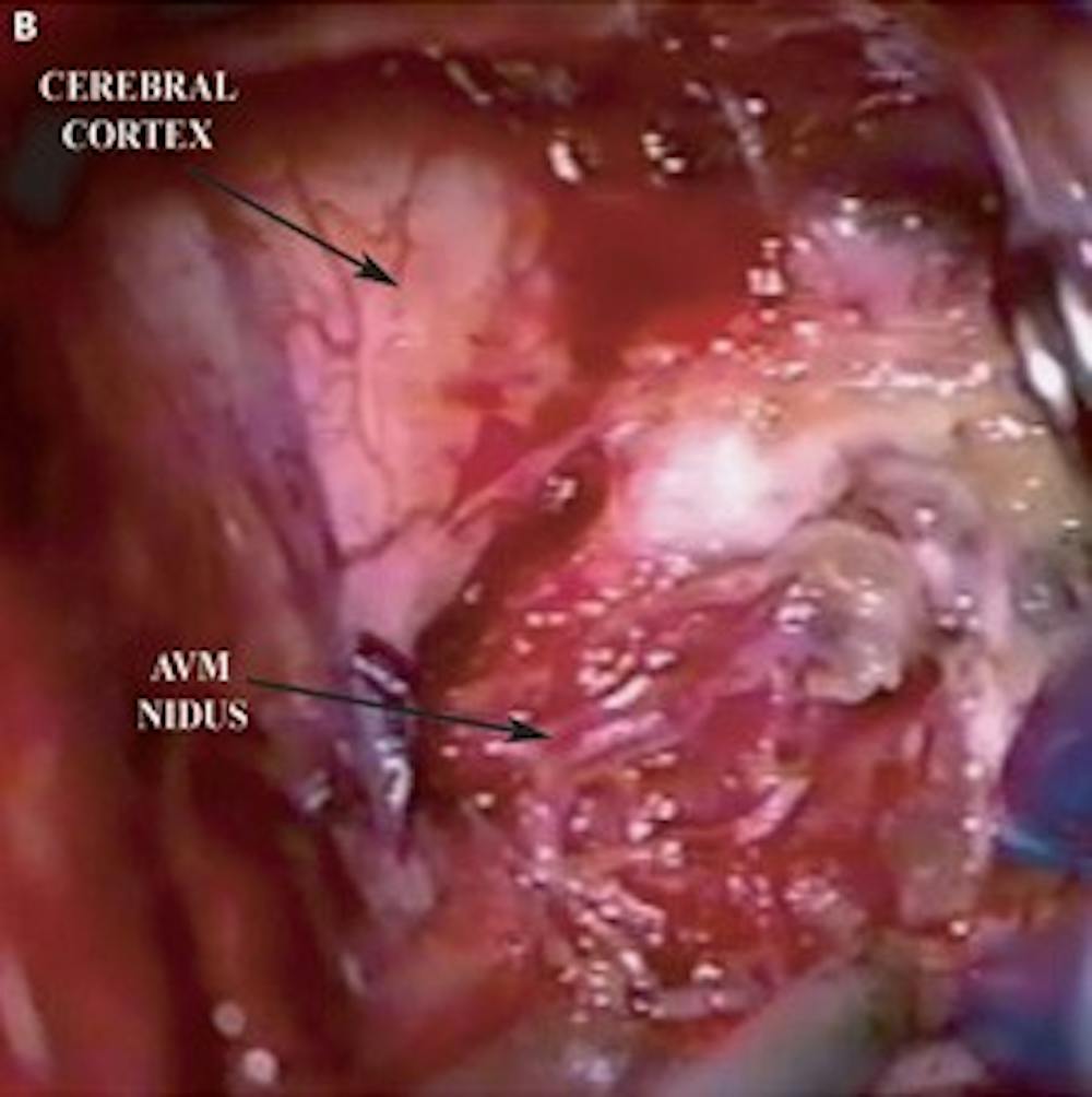 Intra-operative photo demonstrating the AVM nidus